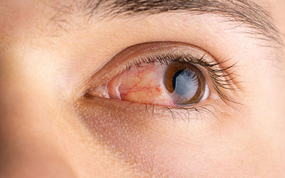 Красные глаза - клиника Угодие