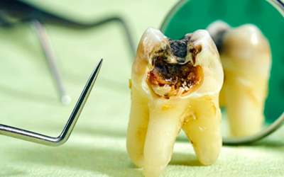 Разрушение зубов - Угодие