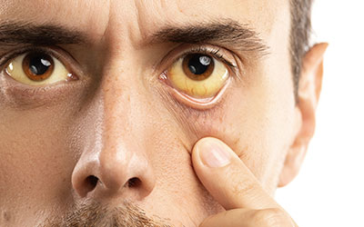 Один из симптомов пожелтение белков глаз - Угодие